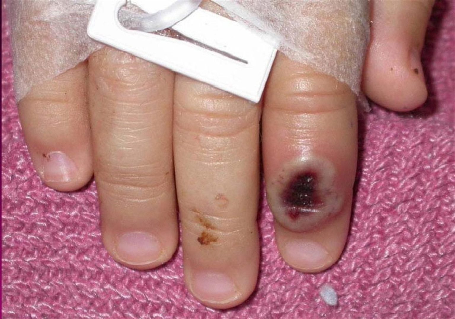 Fotografía de archivo del Centro Estadounidense de Control de las Enfermedades (CDC) en la que se aprecia el dedo de un niño infectado por la llamada "viruela de mono" EFE/Cortesía CDC/SOLO USO EDITORIAL/NO VENTAS/DISPONIBLE PARA ILUSTRAR LA NOTA QUE ACOMPAÑA (CRÉDITO OBLIGATORIO)