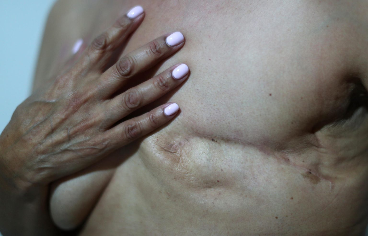 Fotografía de archivo de una mujer que se realizó una mastectomía consecuencia del cáncer de seno. EFE/Sáshenka Gutiérrez