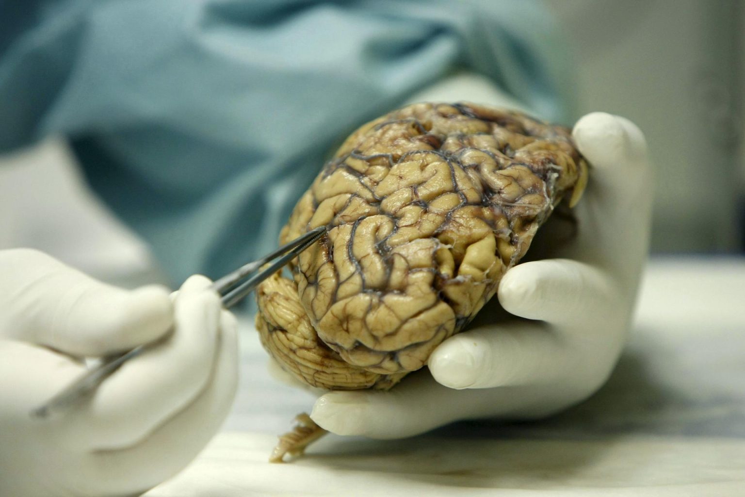 Fotografía de archivo de un médico mientras analiza un cerebro humano. EFE/Fernando Alvarado